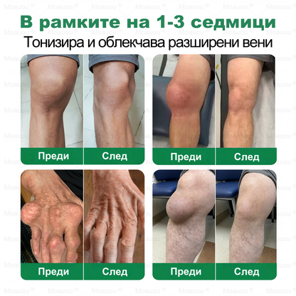 Moauou® Крем за вени и стави – целенасочено действие ⚡ Мигновено облекчение, дълготрайни резултати | Голяма разпродажба!